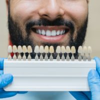 Dental care, implants for veneers. Man with perfect smile choosing teeth tooth tone at dental clinic
